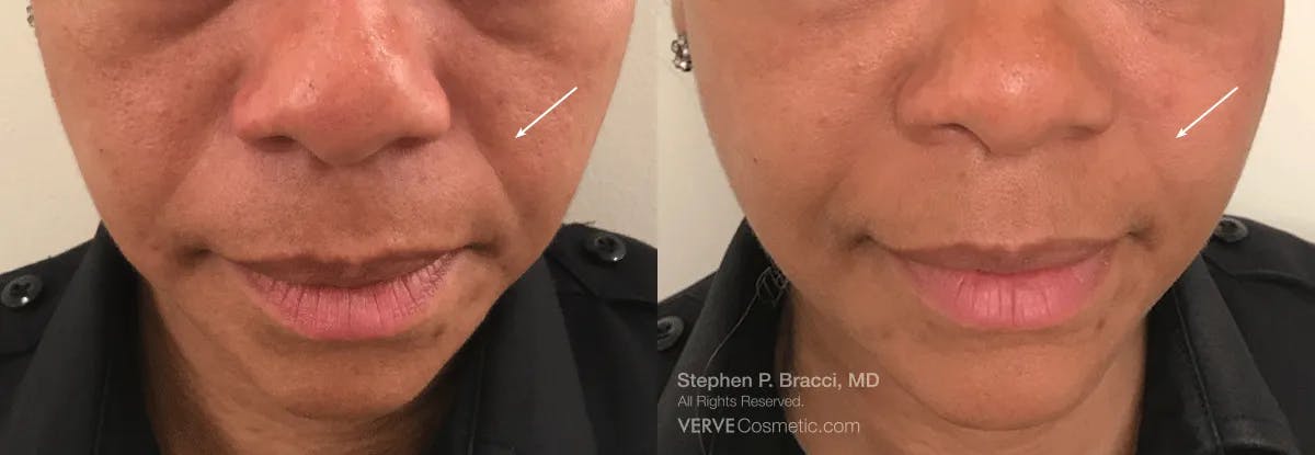 Nasolabial Folds & Marionette Lines Before & After Gallery - Patient 366962 - Image 1