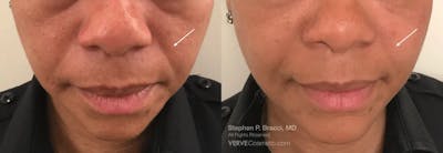 Nasolabial Folds & Marionette Lines Before & After Gallery - Patient 366962 - Image 1