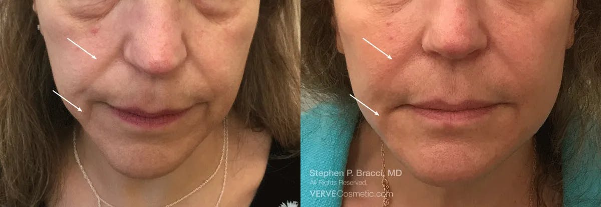 Nasolabial Folds & Marionette Lines Before & After Gallery - Patient 793163 - Image 1