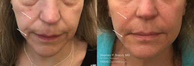 Nasolabial Folds & Marionette Lines Before & After Gallery - Patient 793163 - Image 1