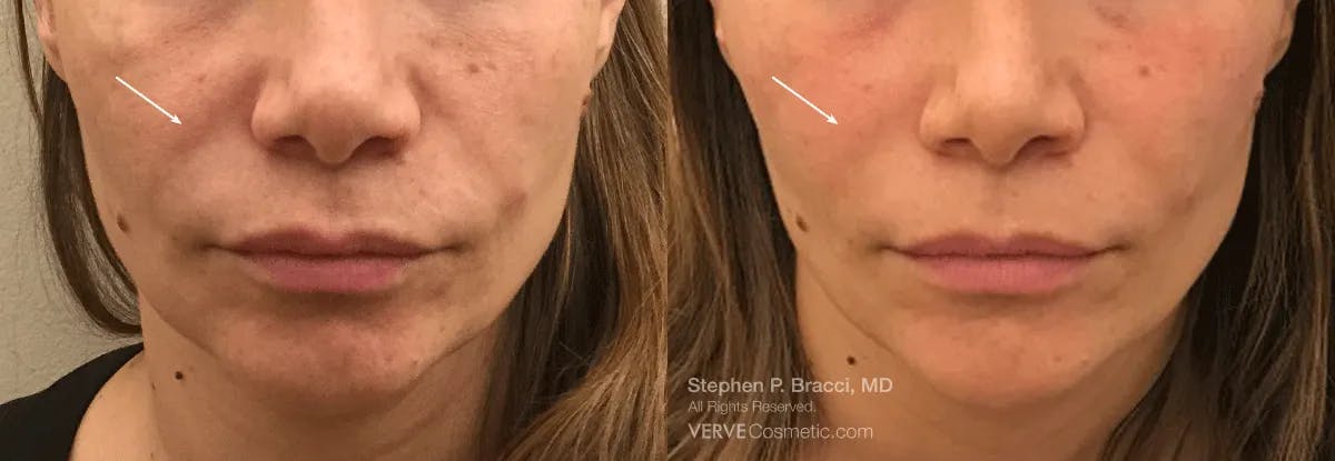 Nasolabial Folds & Marionette Lines Before & After Gallery - Patient 178280 - Image 1