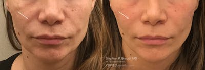 Nasolabial Folds & Marionette Lines Before & After Gallery - Patient 178280 - Image 1