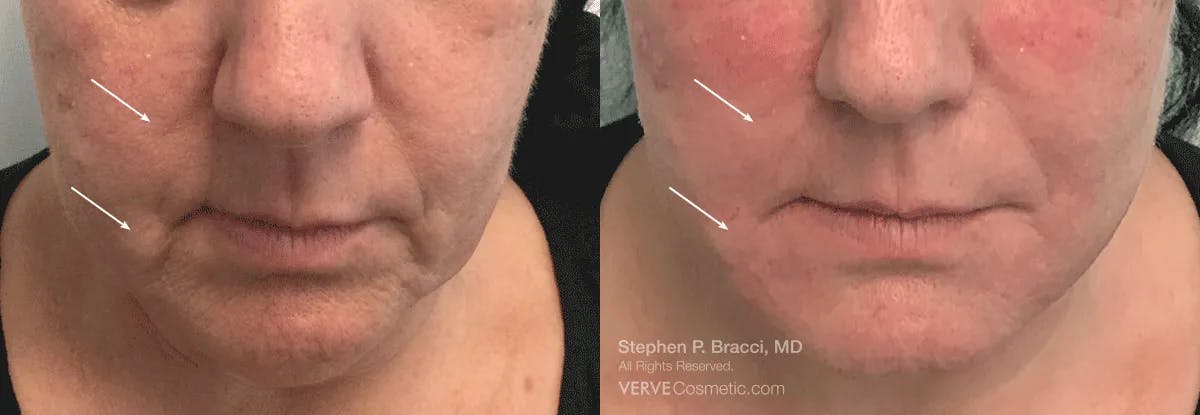 Nasolabial Folds & Marionette Lines Before & After Gallery - Patient 290690 - Image 1
