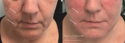 Nasolabial Folds & Marionette Lines Before & After Gallery - Patient 290690 - Image 1