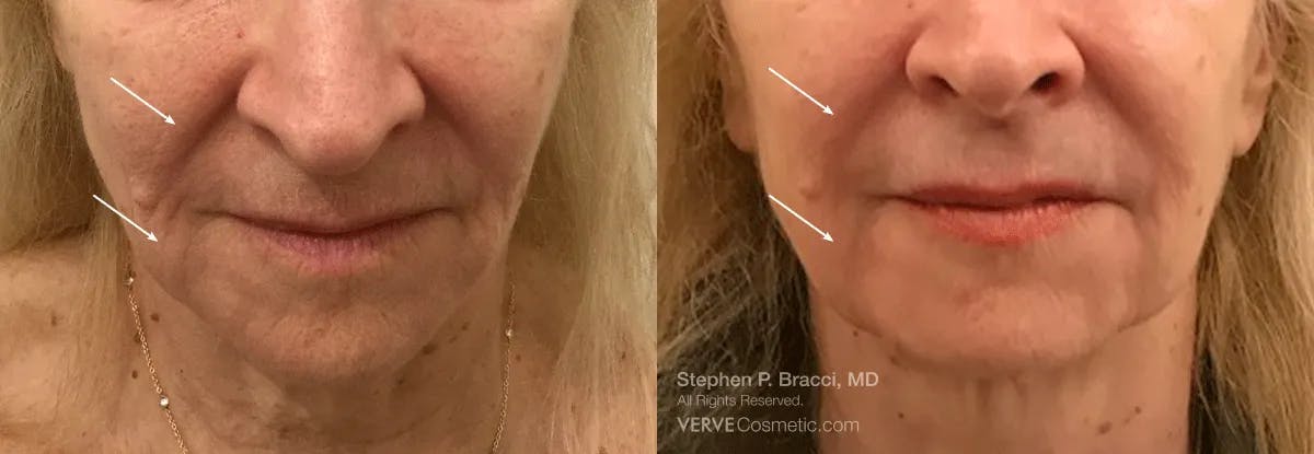 Nasolabial Folds & Marionette Lines Before & After Gallery - Patient 407012 - Image 1