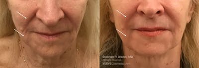 Nasolabial Folds & Marionette Lines Before & After Gallery - Patient 407012 - Image 1