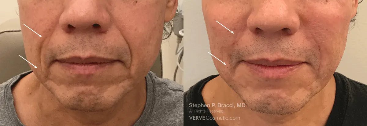 Nasolabial Folds & Marionette Lines Before & After Gallery - Patient 382456 - Image 1