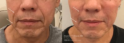 Nasolabial Folds & Marionette Lines Before & After Gallery - Patient 382456 - Image 1