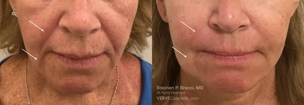 Nasolabial Folds & Marionette Lines Before & After Gallery - Patient 890391 - Image 1
