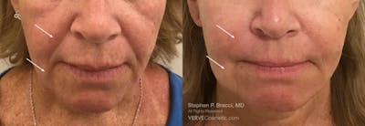 Nasolabial Folds & Marionette Lines Before & After Gallery - Patient 890391 - Image 1