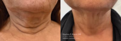 Neck Before & After Gallery - Patient 816656 - Image 1