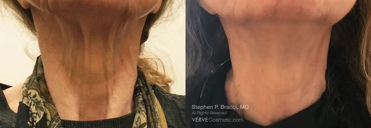 Neck Before & After Gallery - Patient 424950 - Image 1