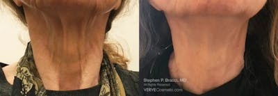 Neck Before & After Gallery - Patient 424950 - Image 1