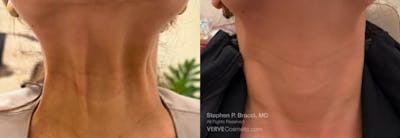 Neck Before & After Gallery - Patient 229287 - Image 1