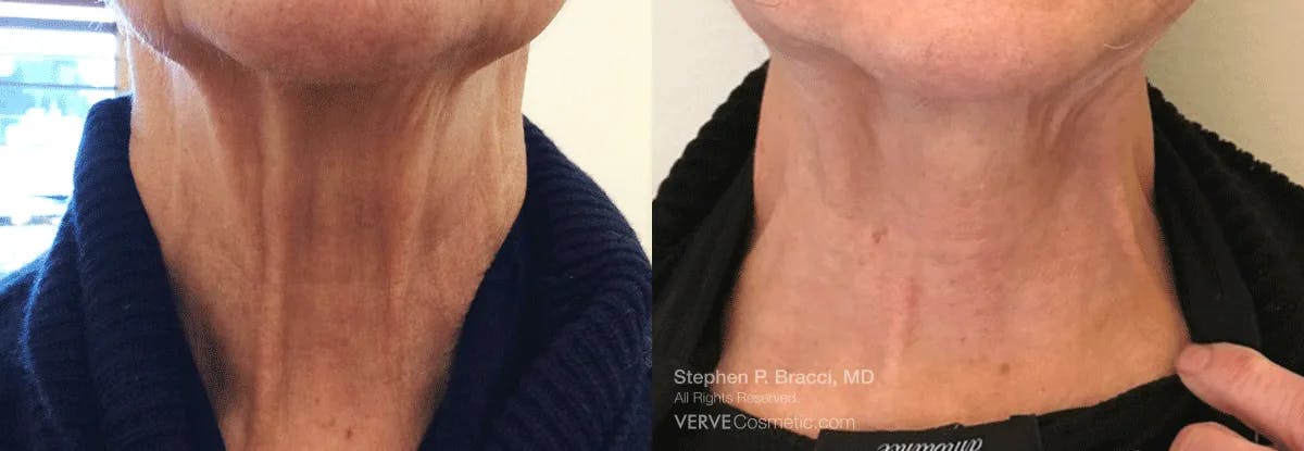 Neck Before & After Gallery - Patient 450827 - Image 1
