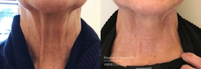 Neck Before & After Gallery - Patient 450827 - Image 1