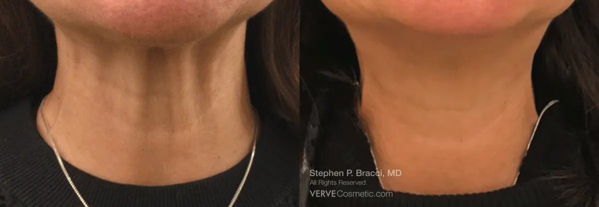 Neck Before & After Gallery - Patient 295041 - Image 1
