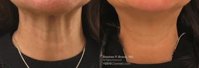 Neck Before & After Gallery - Patient 295041 - Image 1