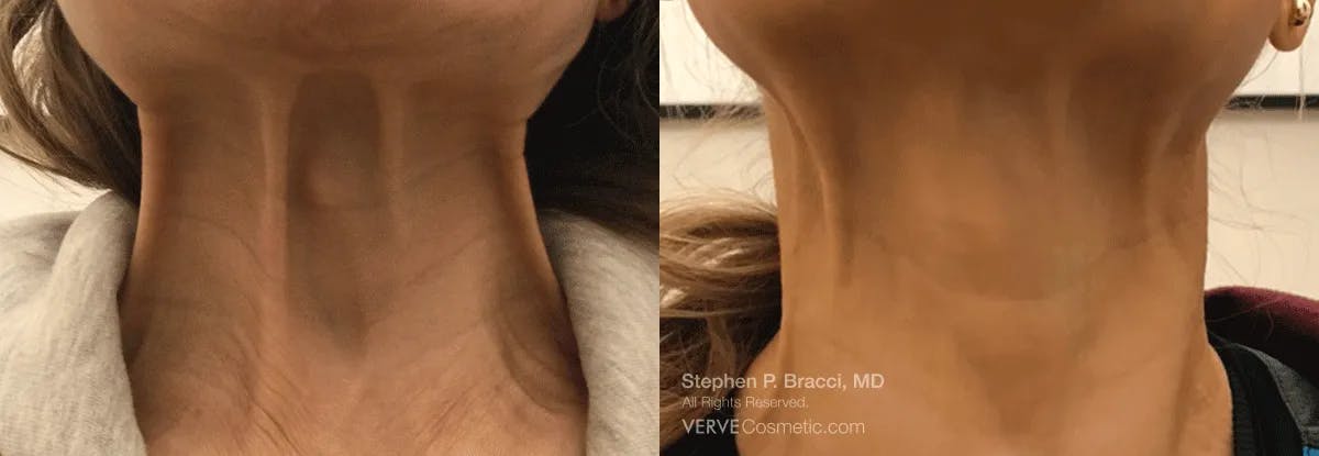 Neck Before & After Gallery - Patient 252179 - Image 1
