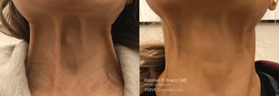 Neck Before & After Gallery - Patient 252179 - Image 1