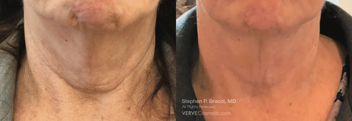 Neck Before & After Gallery - Patient 348965 - Image 1