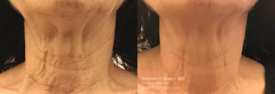 Neck Before & After Gallery - Patient 249831 - Image 1