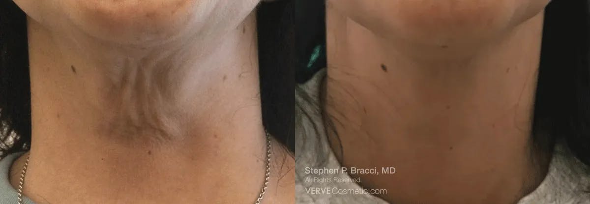Neck Before & After Gallery - Patient 336660 - Image 1