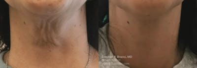 Neck Before & After Gallery - Patient 336660 - Image 1