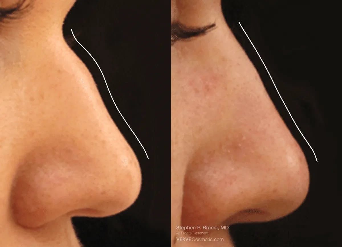 Nose Before & After Gallery - Patient 118530 - Image 1