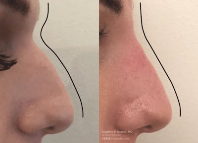 Nose Before & After Gallery - Patient 404154 - Image 1