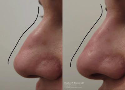 Nose Before & After Gallery - Patient 782800 - Image 1