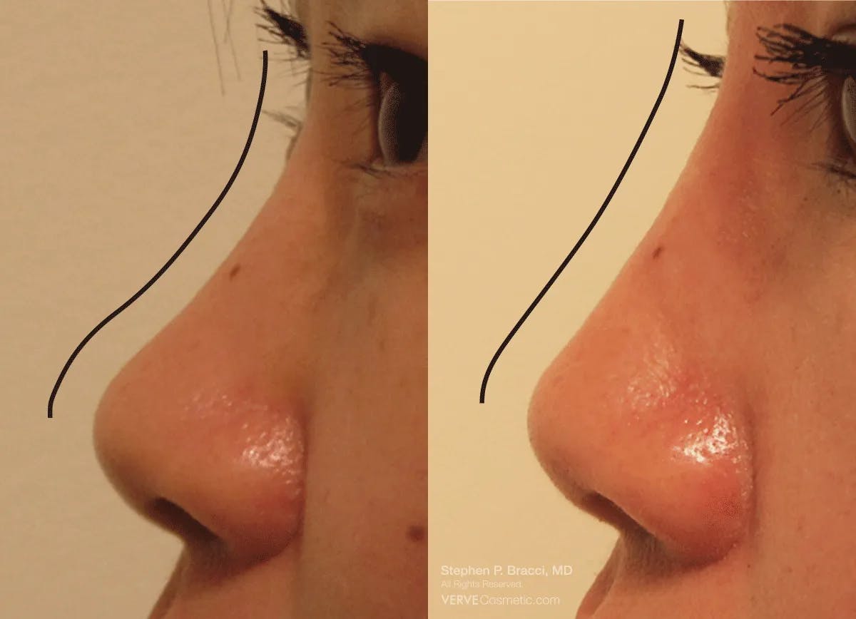 Nose Before & After Gallery - Patient 138129 - Image 1