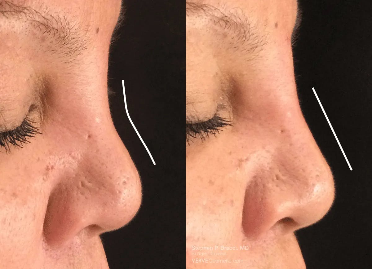 Nose Before & After Gallery - Patient 126787 - Image 1