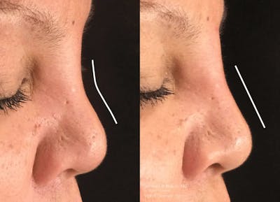 Nose Before & After Gallery - Patient 126787 - Image 1