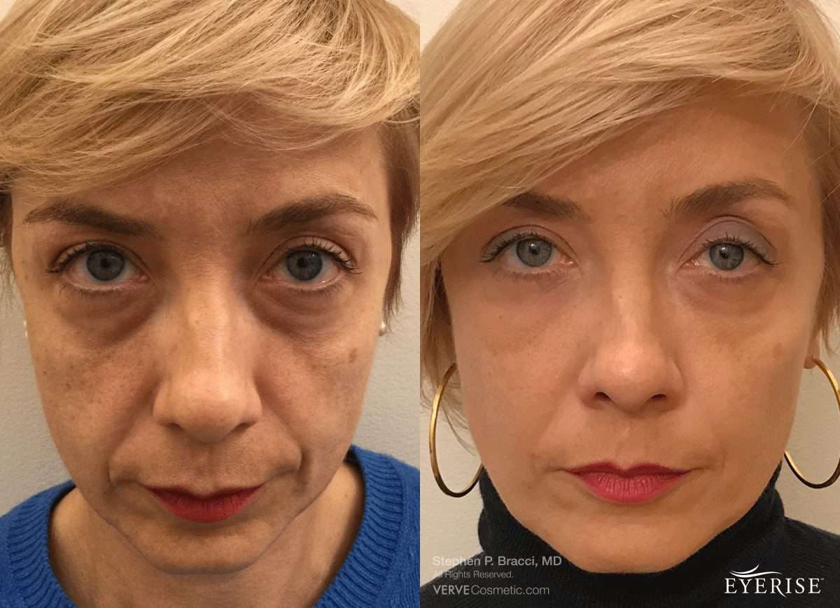 Eyerise™ Before & After Gallery - Patient 591454 - Image 1