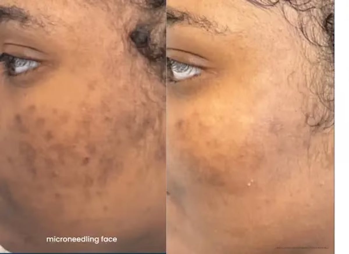 Microneedling Before & After Gallery - Patient 751075 - Image 1