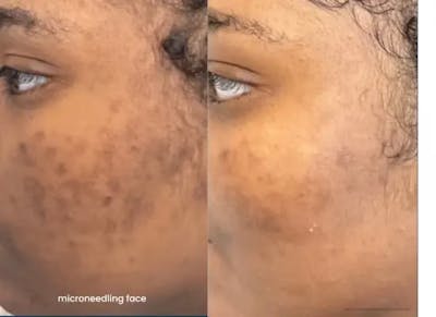 Microneedling Before & After Gallery - Patient 751075 - Image 1