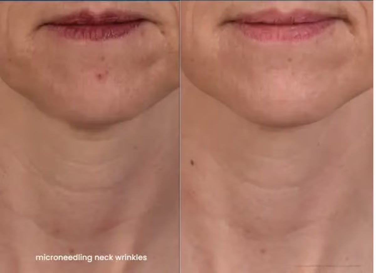 Microneedling Before & After Gallery - Patient 324167 - Image 1
