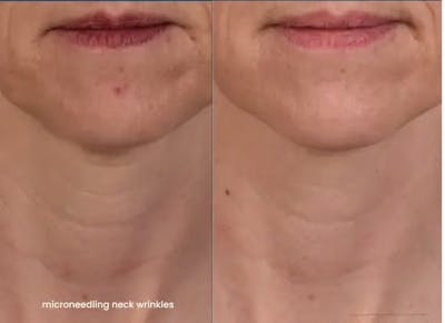 Microneedling Before & After Gallery - Patient 324167 - Image 1
