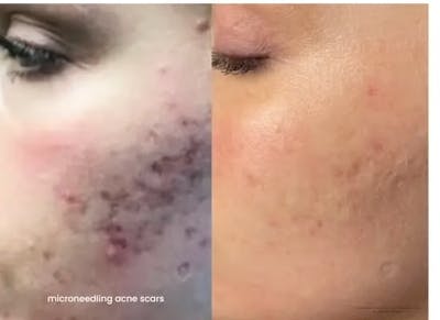 Microneedling Before & After Gallery - Patient 325538 - Image 1