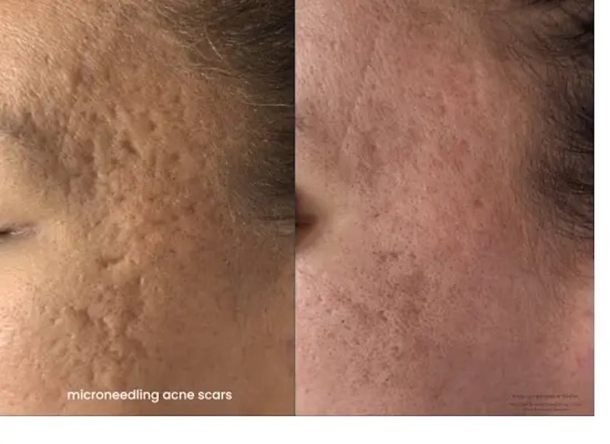 Microneedling Before & After Gallery - Patient 329089 - Image 1