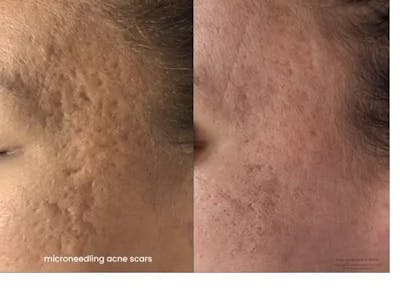 Microneedling Before & After Gallery - Patient 329089 - Image 1
