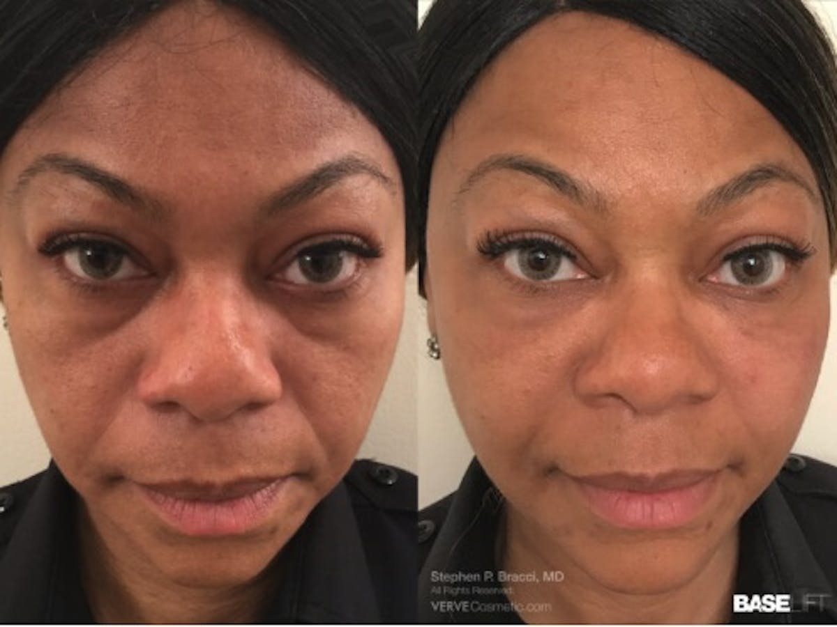 Cheekbone Filler Before & After Gallery - Patient 344001 - Image 1
