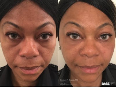 Cheekbone Filler Before & After Gallery - Patient 344001 - Image 1