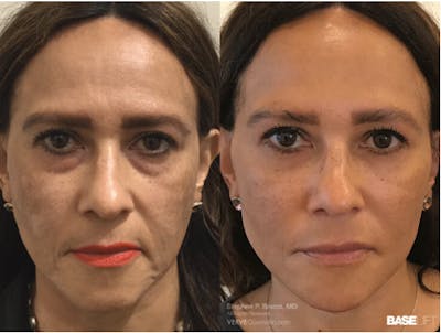Cheekbone Filler Before & After Gallery - Patient 308403 - Image 1