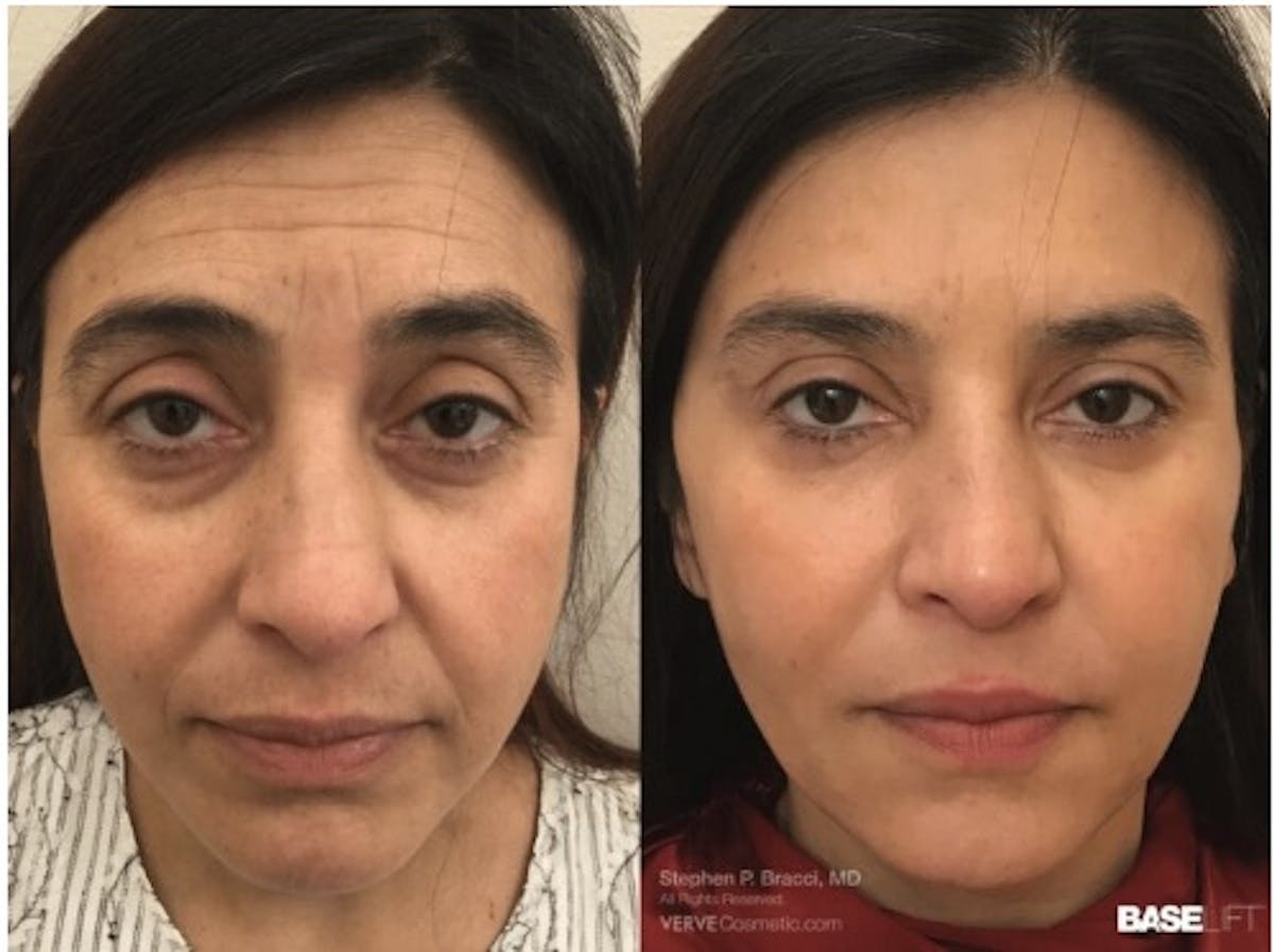 Cheekbone Filler Before & After Gallery - Patient 303536 - Image 1
