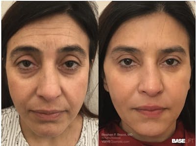 Cheekbone Filler Before & After Gallery - Patient 303536 - Image 1