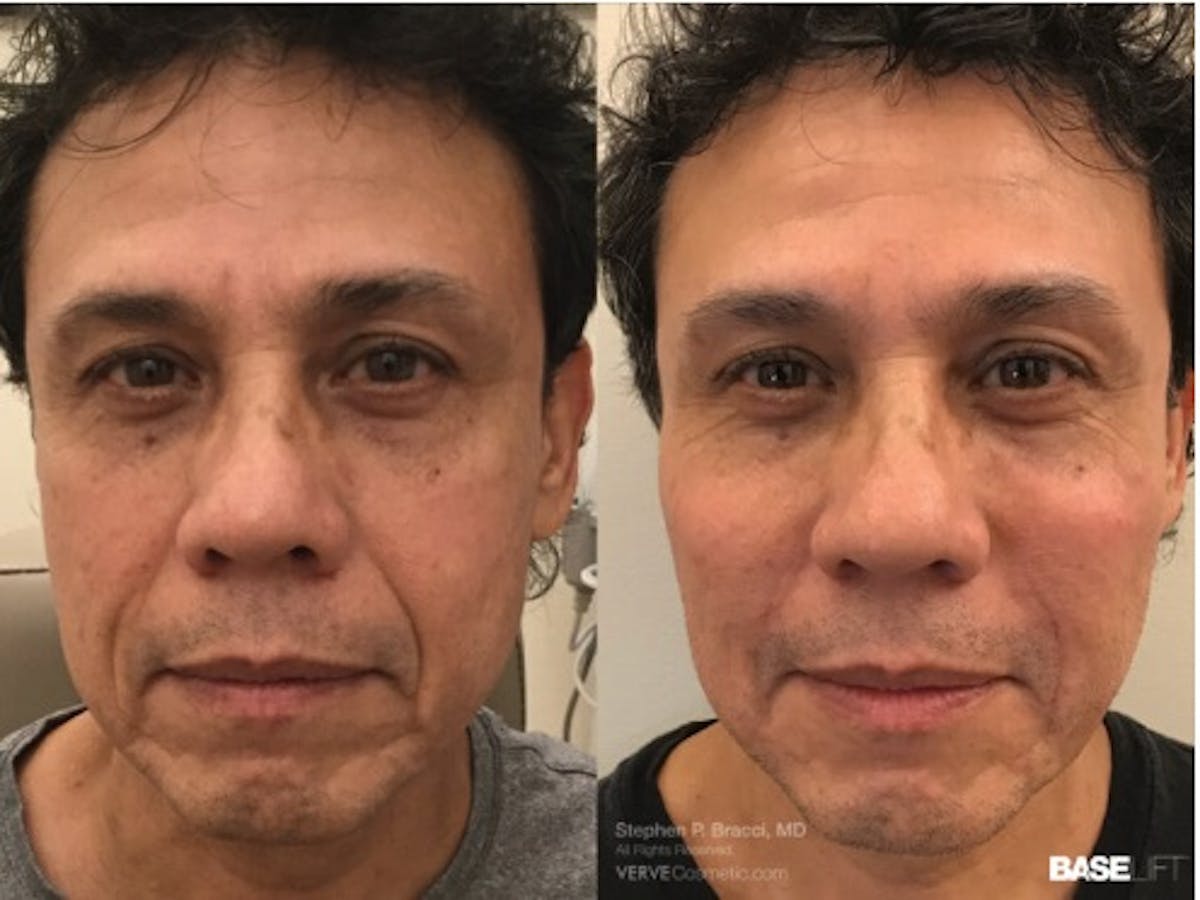 Cheekbone Filler Before & After Gallery - Patient 140469 - Image 1