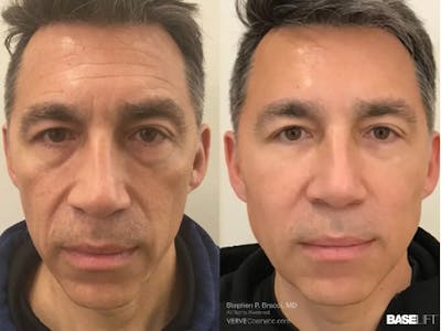 Cheekbone Filler Before & After Gallery - Patient 169037 - Image 1