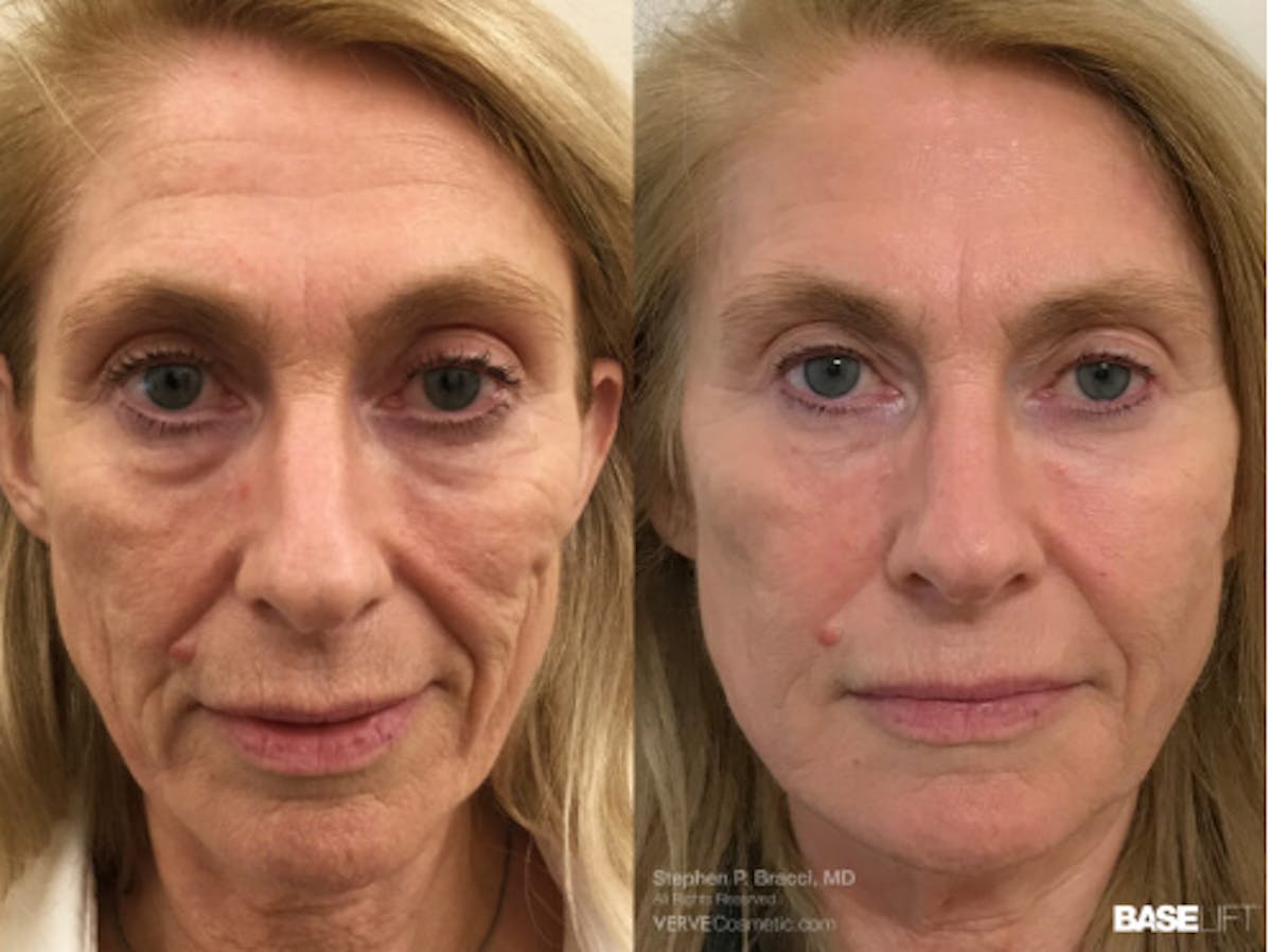 Cheekbone Filler Before & After Gallery - Patient 113313 - Image 1